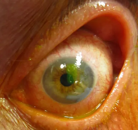 slit lamp photograph of a cornea under blue light with fluorescein, diagnosis hidden