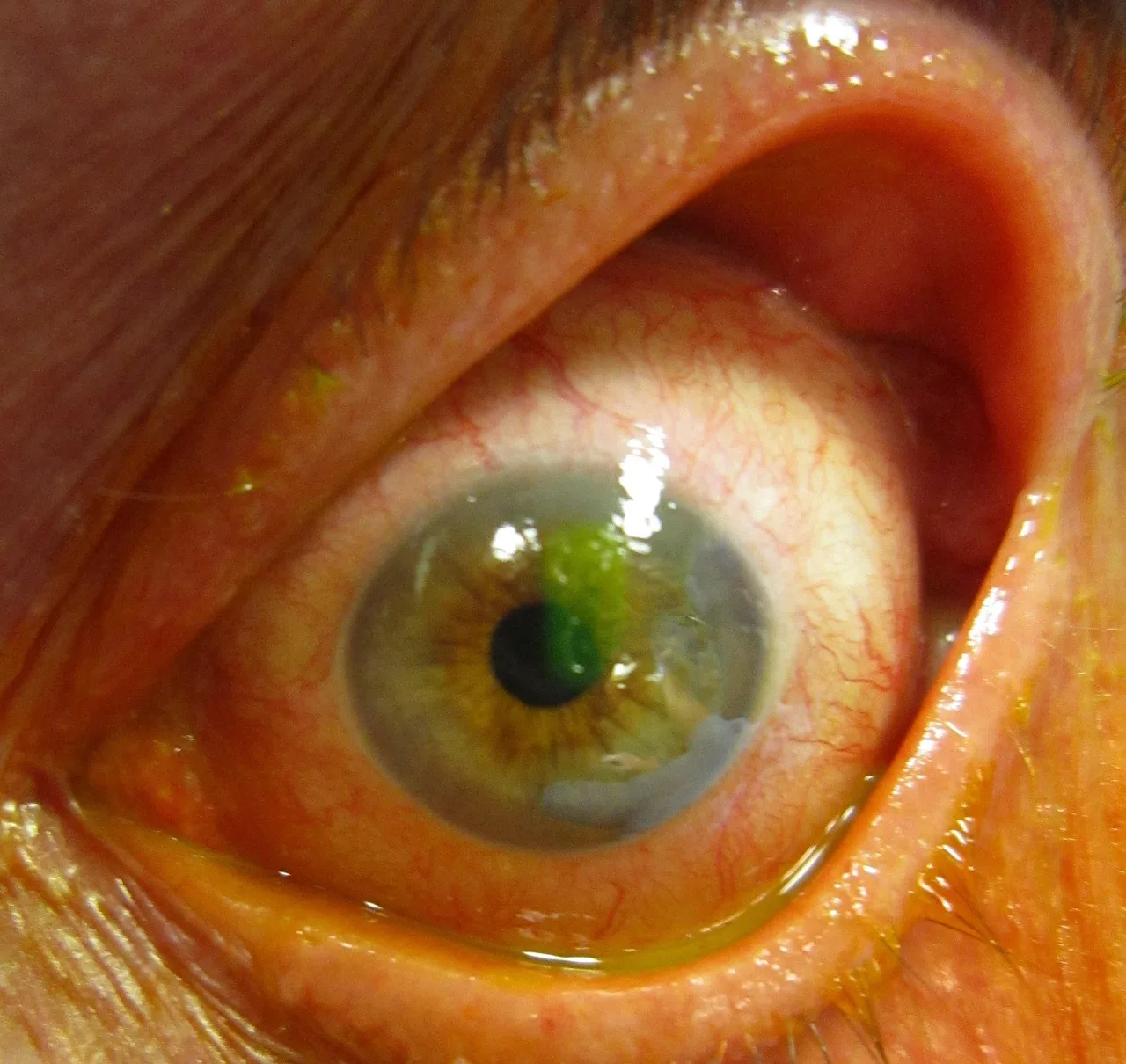 slit lamp photograph of a cornea under blue light with fluorescein, diagnosis hidden