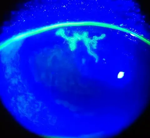 slit lamp photograph of a cornea under blue light with fluorescein, diagnosis hidden