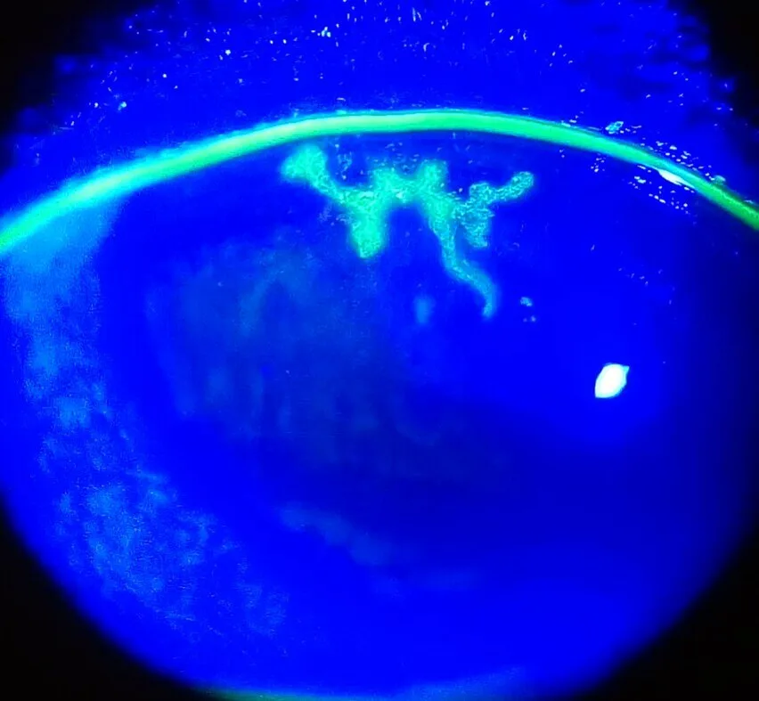 slit lamp photograph of a cornea under blue light with fluorescein, diagnosis hidden