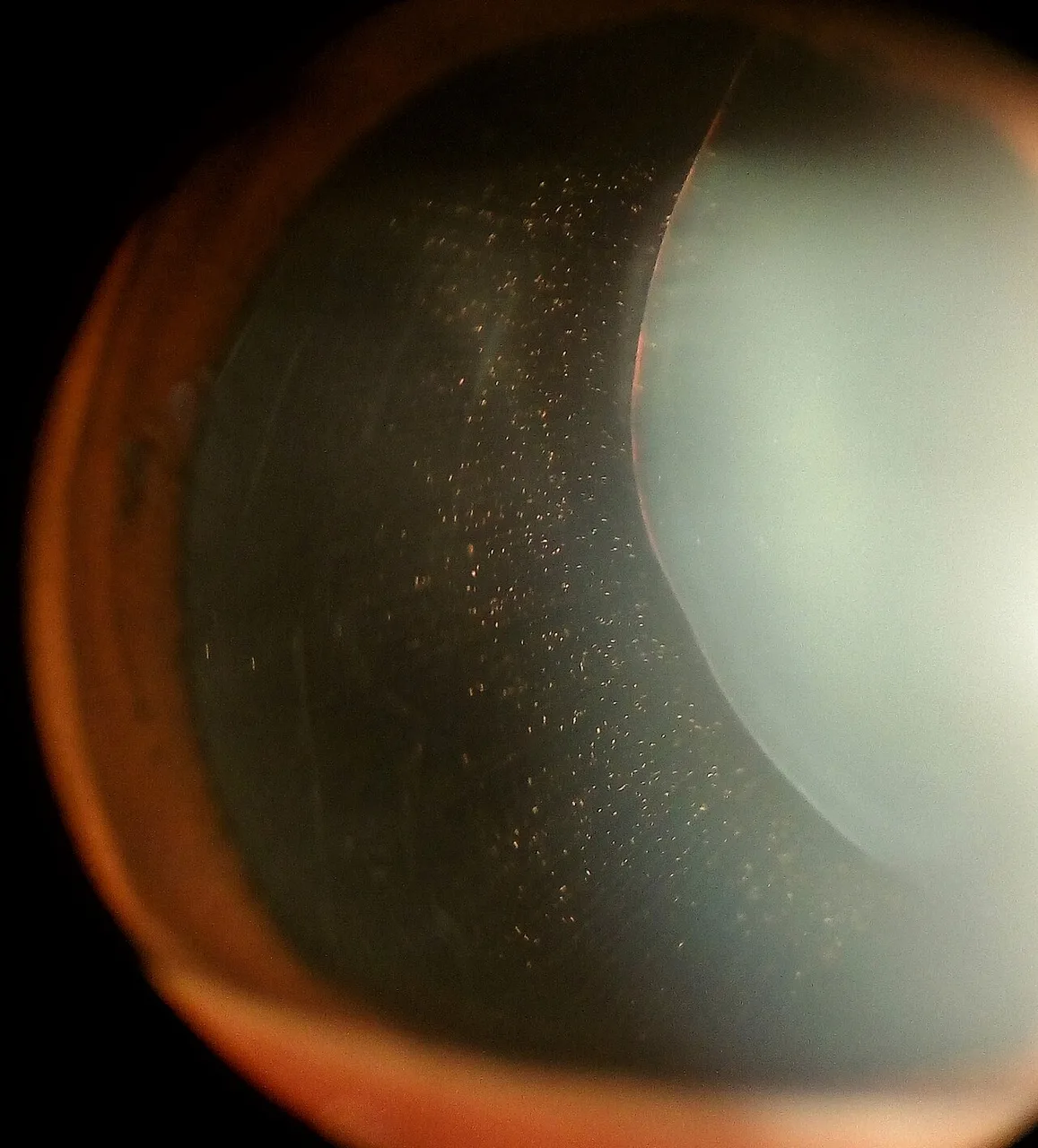 slit lamp photograph through a dilated pupil, diagnosis hidden
