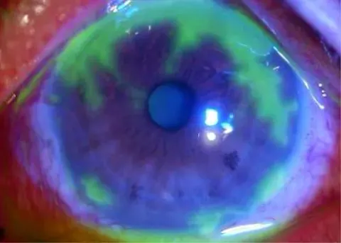 slit lamp photograph of a cornea under blue light with fluorescein, diagnosis hidden