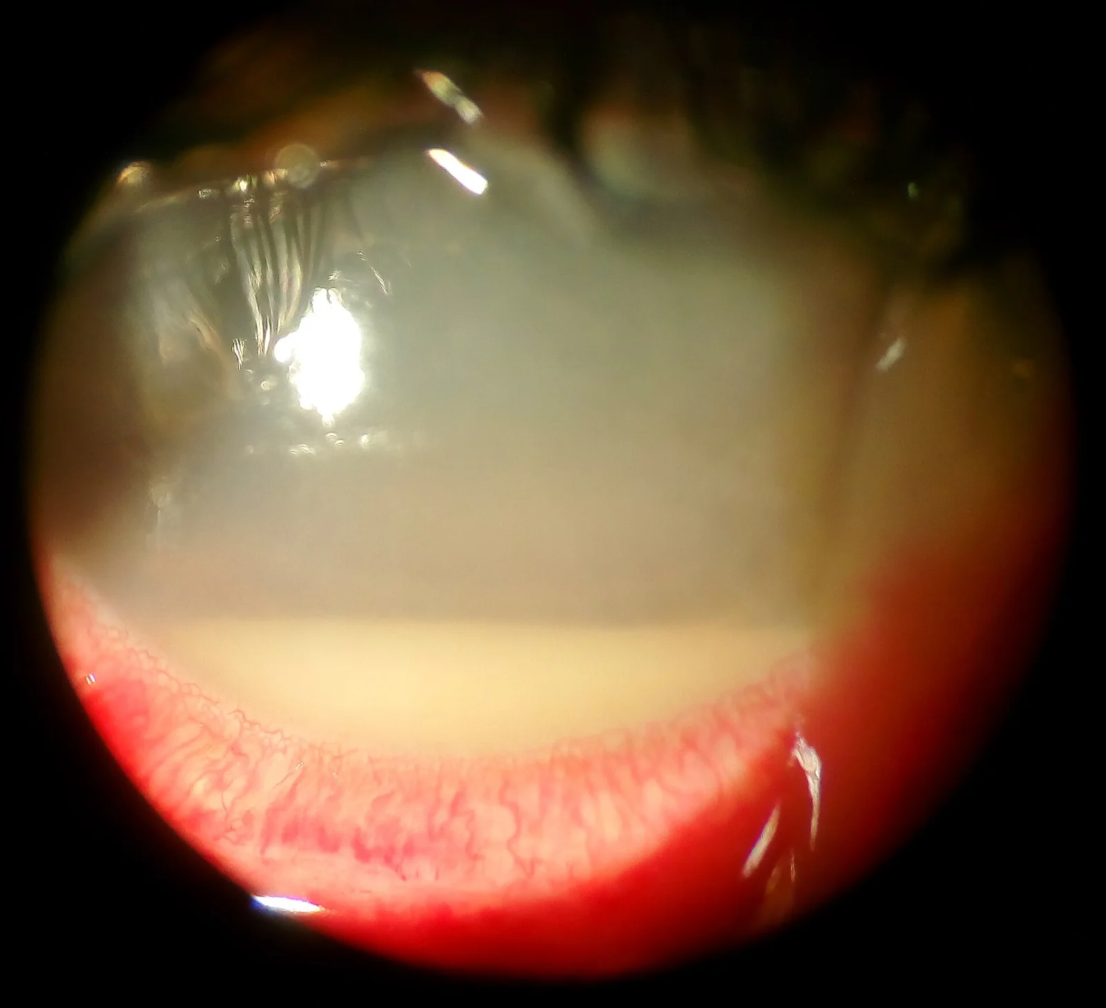 slit lamp image, diagnosis hidden