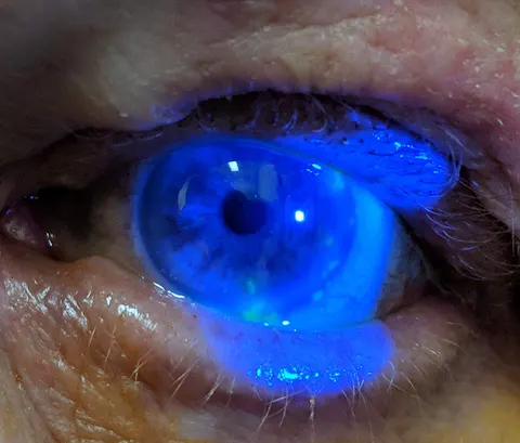 slit lamp image, diagnosis hidden