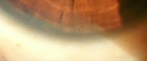 slit lamp close-up of the corneal periphery, diagnosis hidden