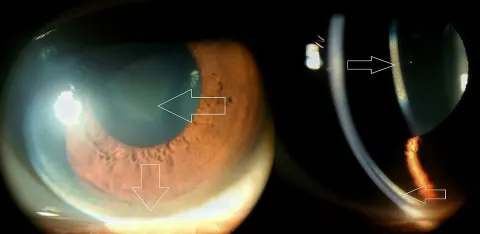 two slit lamp photographs with arrows from the source