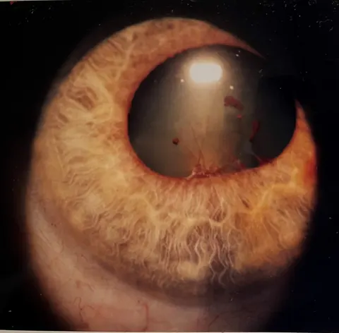 slit lamp image, diagnosis hidden