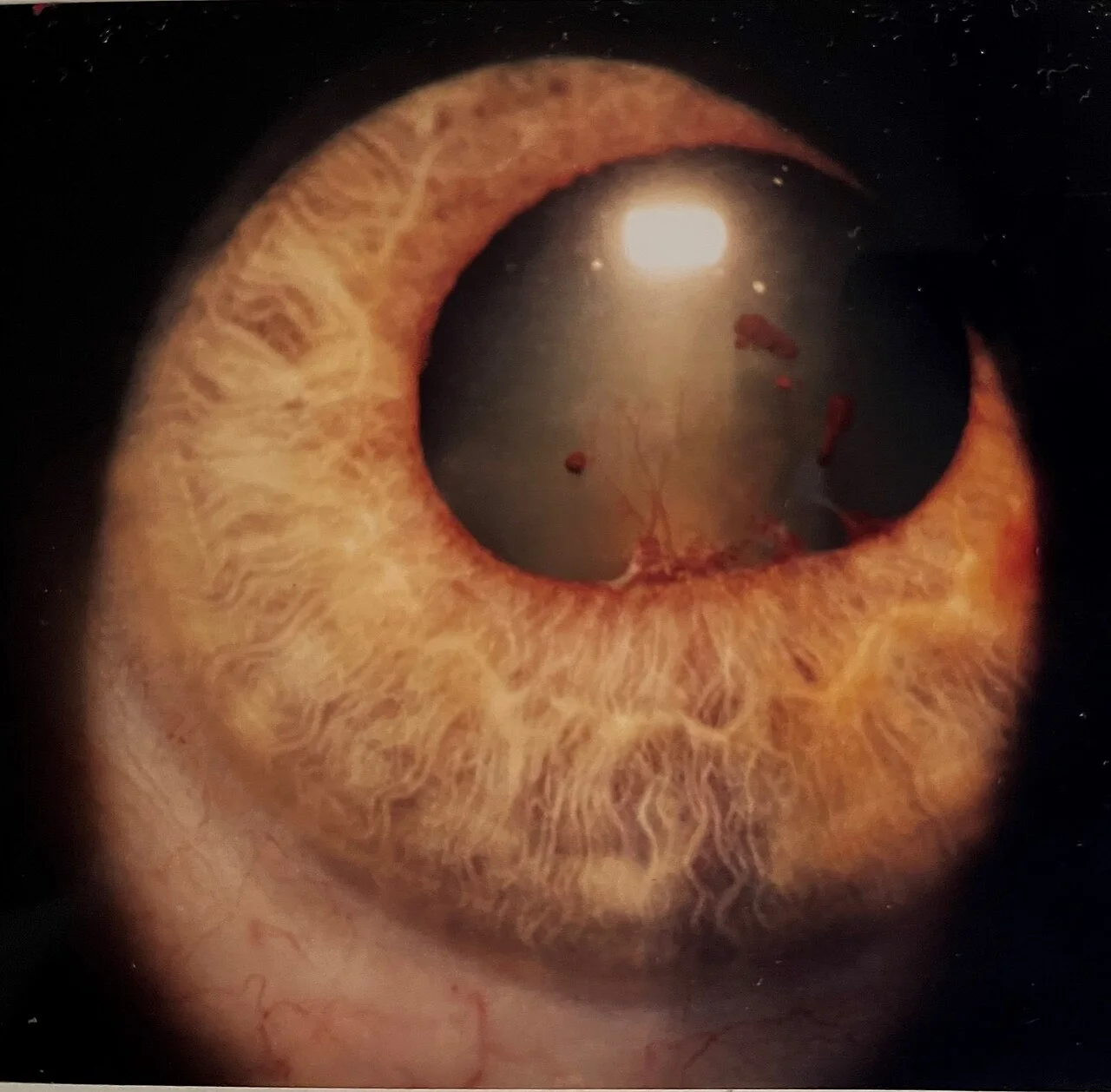 slit lamp study, the diagnosis is hidden until you answer