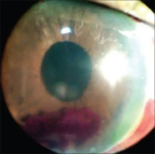 slit lamp study, the diagnosis is hidden until you answer