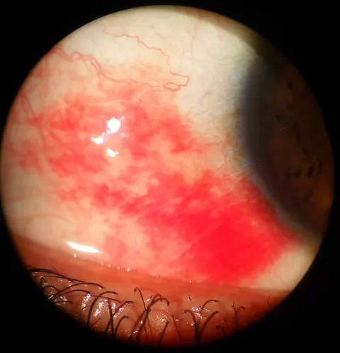 slit lamp image, diagnosis hidden