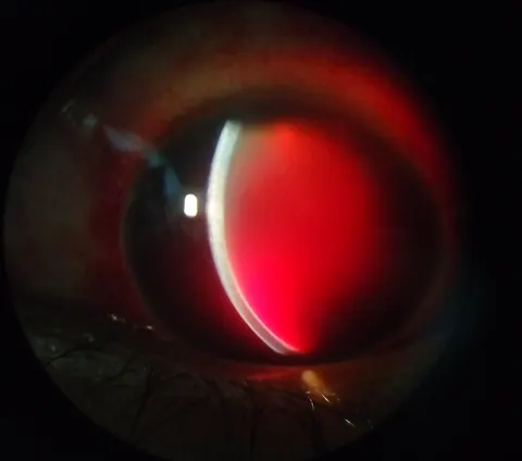 slit lamp image, diagnosis hidden