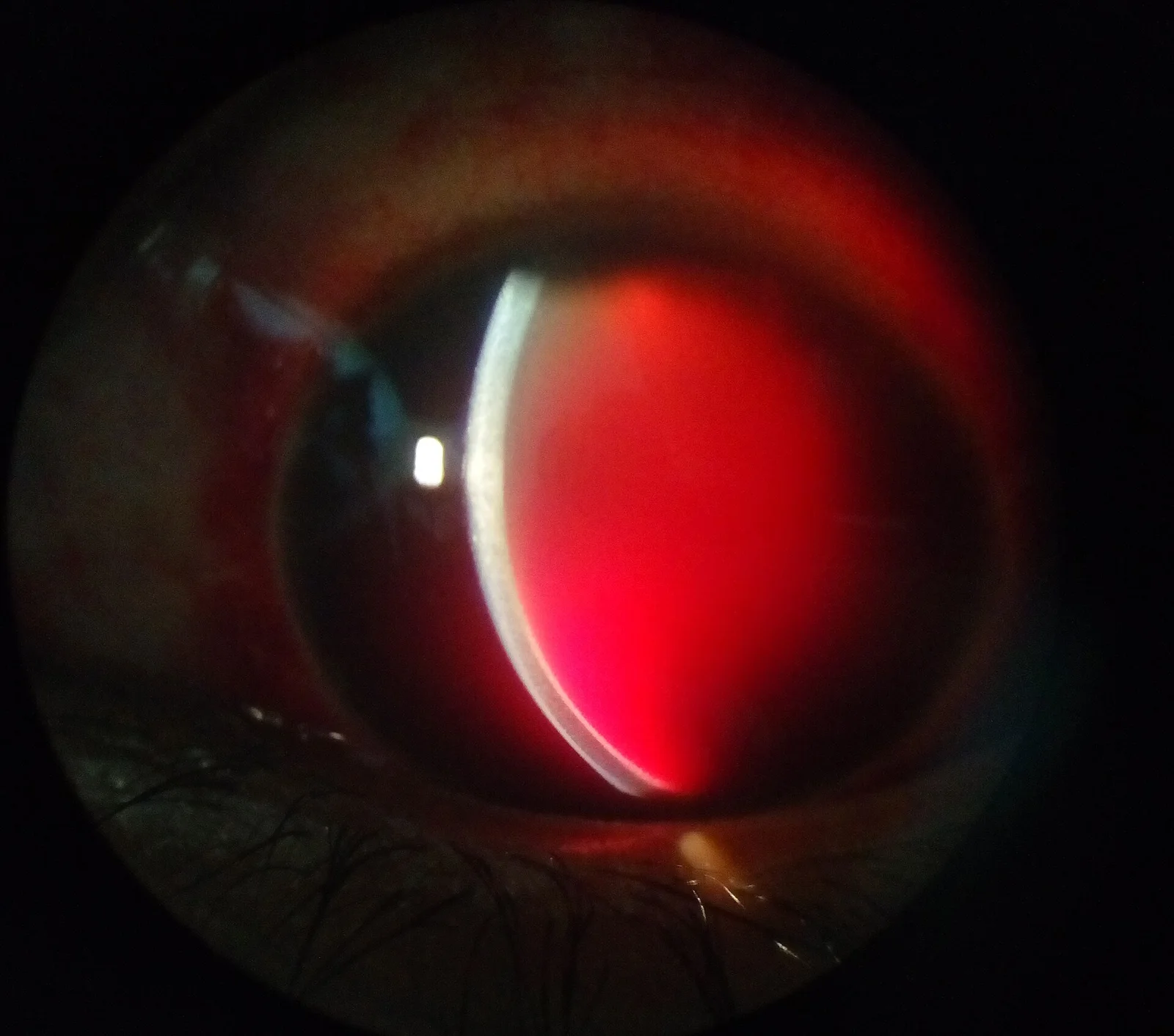 slit lamp study, the diagnosis is hidden until you answer