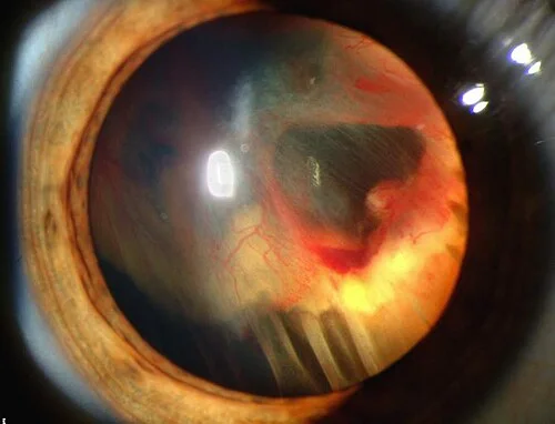 slit lamp study, the diagnosis is hidden until you answer