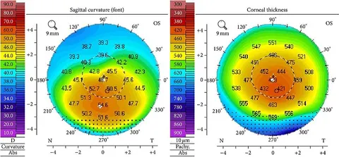 corneal topography image, diagnosis hidden