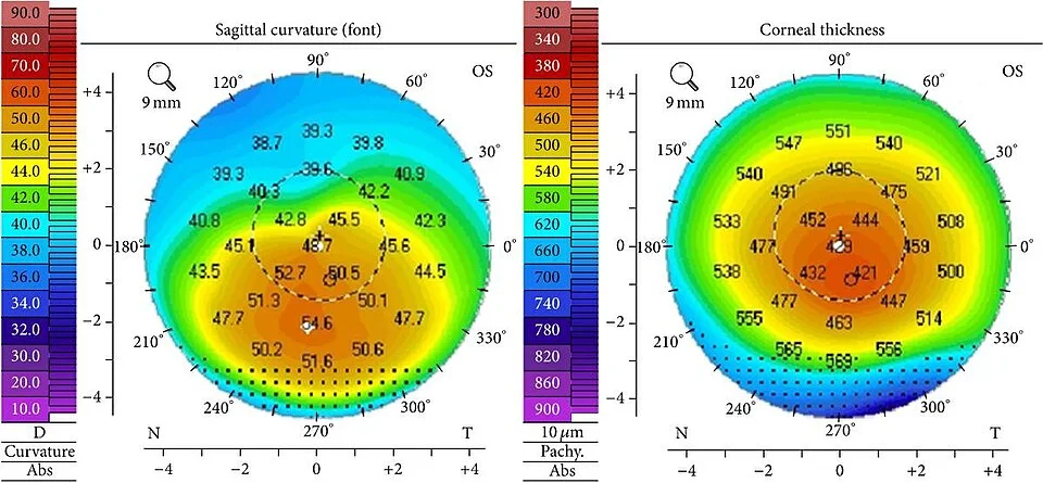 corneal topography study, the diagnosis is hidden until you answer