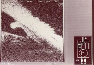 Angle closure on ultrasound biomicroscopy: Cornea and iris in cross-section