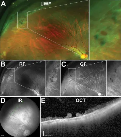 a multi-panel figure: widefield fundus, red-free, green-filter, infrared and OCT images