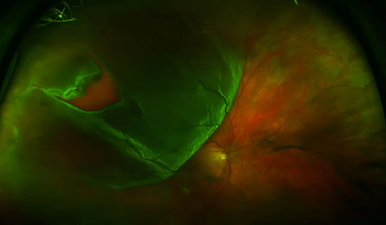 color fundus study, the diagnosis is hidden until you answer