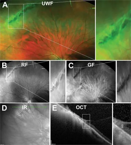 a multi-panel figure: widefield fundus, red-free, green-filter, infrared and OCT images
