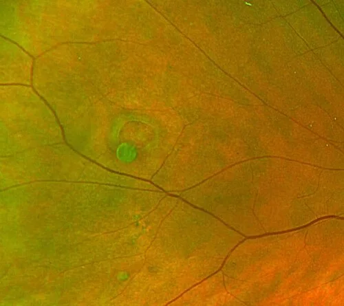 color fundus image, diagnosis hidden
