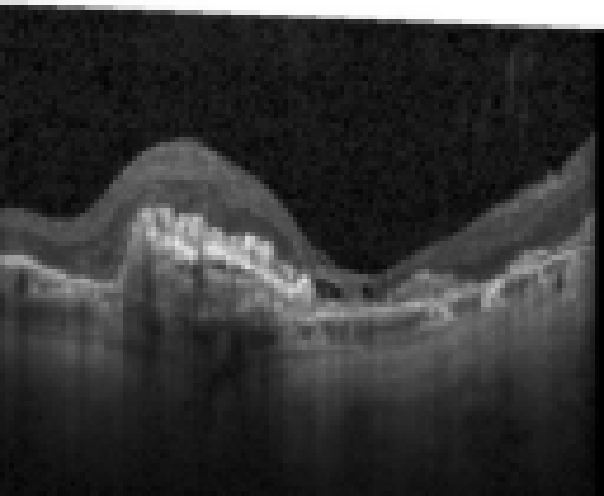 oct macula study, the diagnosis is hidden until you answer