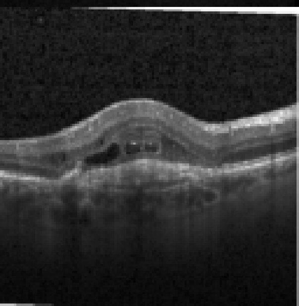 oct macula study, the diagnosis is hidden until you answer
