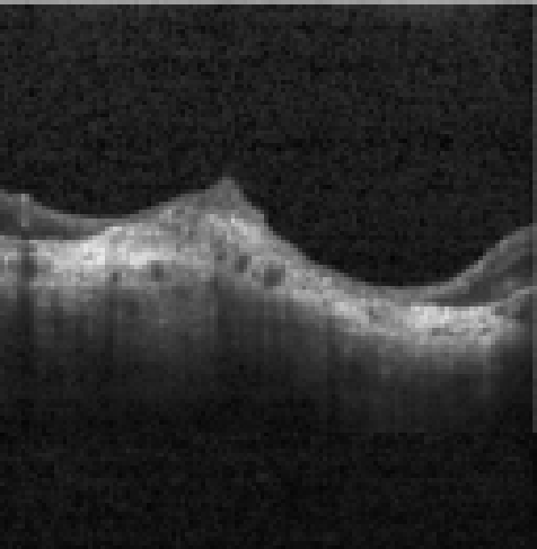 oct macula study, the diagnosis is hidden until you answer
