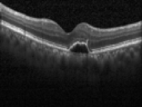 oct macula study, the diagnosis is hidden until you answer