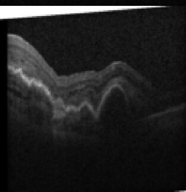 oct macula study, the diagnosis is hidden until you answer