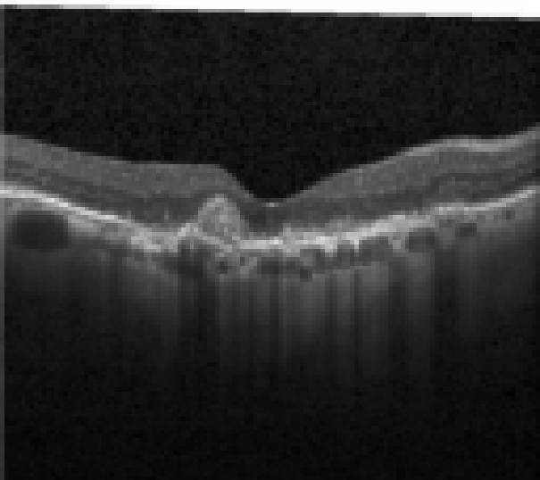 oct macula study, the diagnosis is hidden until you answer