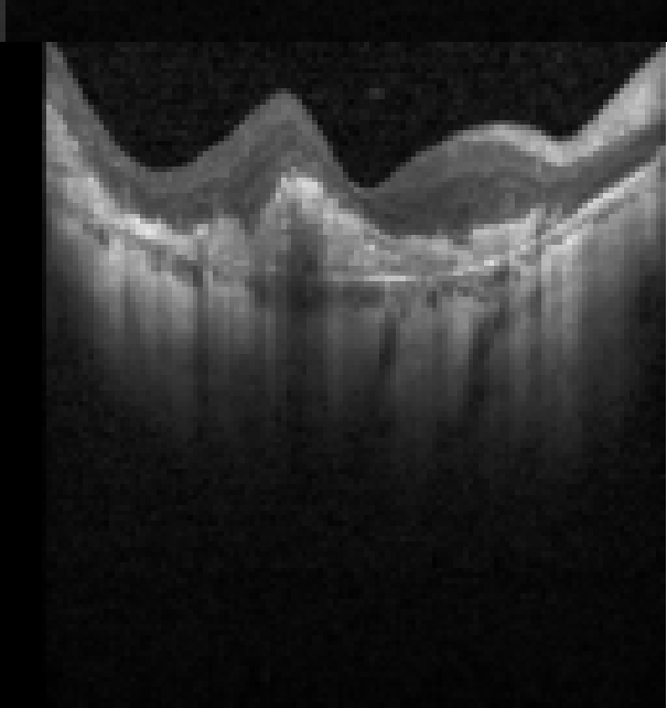 oct macula study, the diagnosis is hidden until you answer