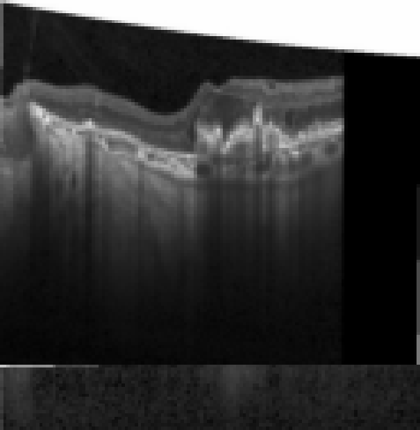 oct macula study, the diagnosis is hidden until you answer