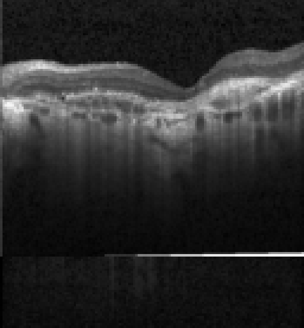 oct macula study, the diagnosis is hidden until you answer