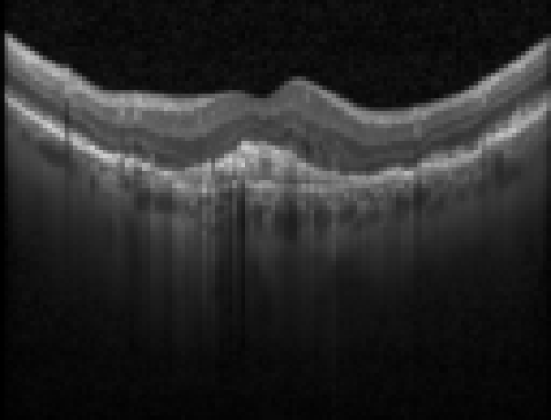 oct macula study, the diagnosis is hidden until you answer