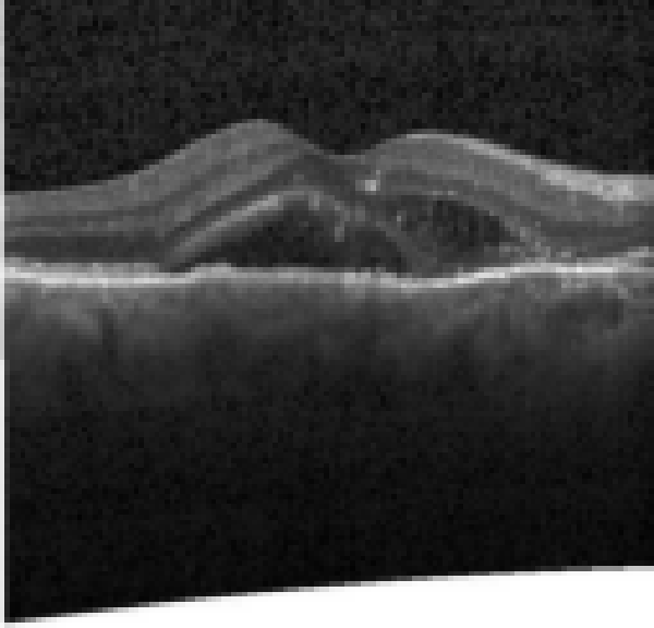 oct macula study, the diagnosis is hidden until you answer