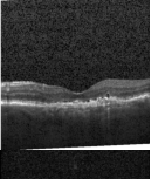 oct macula study, the diagnosis is hidden until you answer