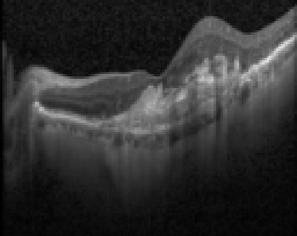 oct macula study, the diagnosis is hidden until you answer