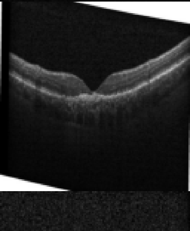 oct macula study, the diagnosis is hidden until you answer