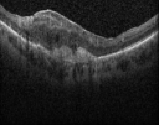 oct macula study, the diagnosis is hidden until you answer