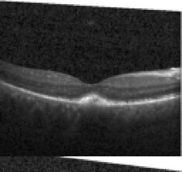 oct macula study, the diagnosis is hidden until you answer