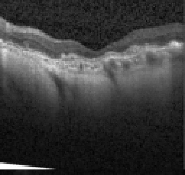 oct macula study, the diagnosis is hidden until you answer