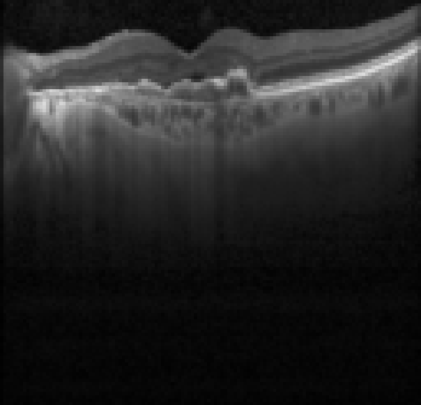 oct macula study, the diagnosis is hidden until you answer