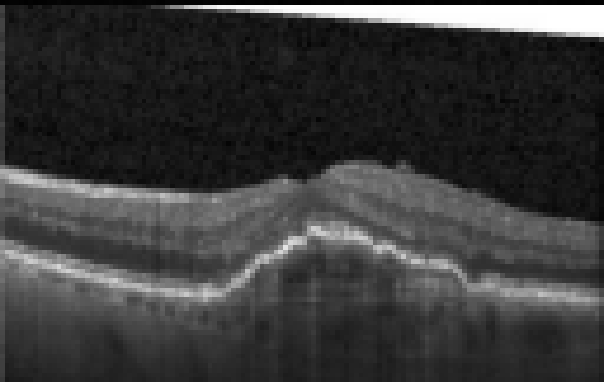 oct macula study, the diagnosis is hidden until you answer