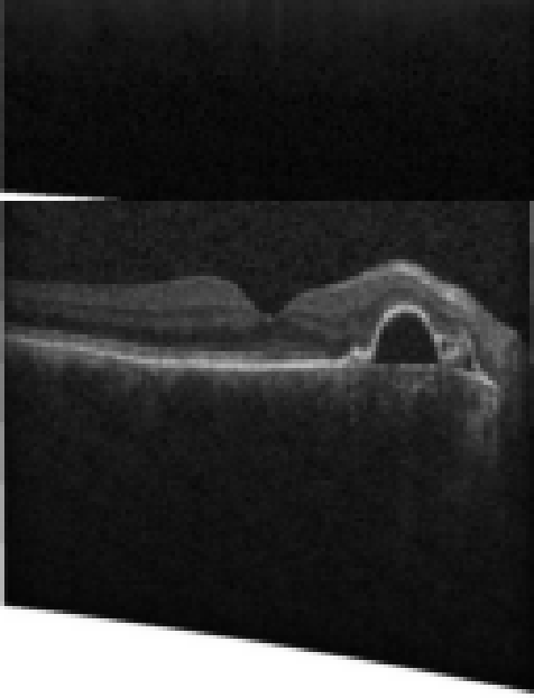 oct macula study, the diagnosis is hidden until you answer