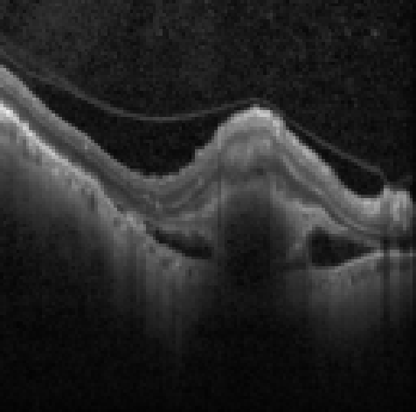 oct macula study, the diagnosis is hidden until you answer