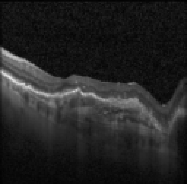 oct macula study, the diagnosis is hidden until you answer
