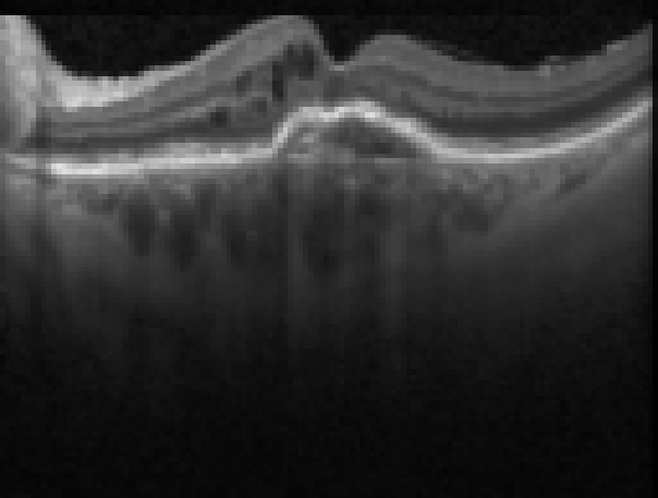 oct macula study, the diagnosis is hidden until you answer