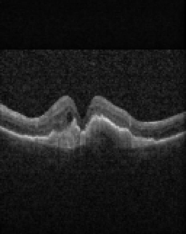 oct macula study, the diagnosis is hidden until you answer