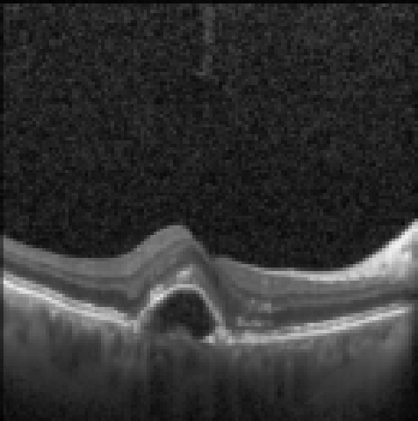 oct macula study, the diagnosis is hidden until you answer