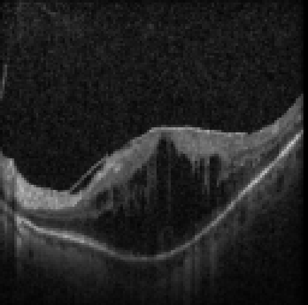 oct macula study, the diagnosis is hidden until you answer